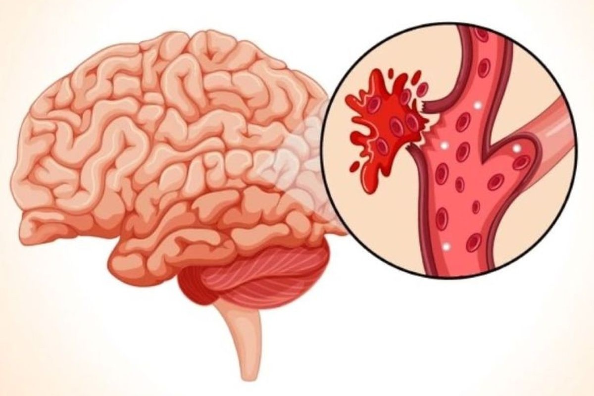 Brain Hemorrhage Treatment