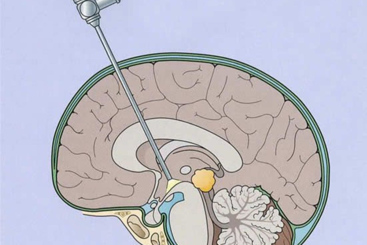 Endoscopic Spine Surgery